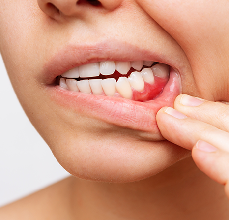 A woman pulling down her lip to show irritated gums.